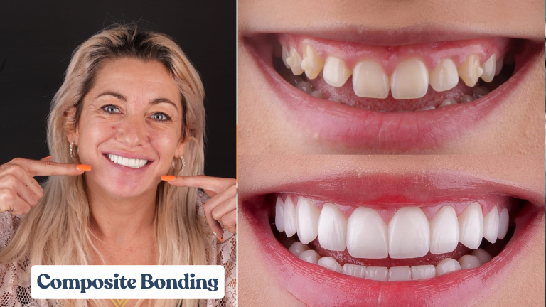 Composite Bonding