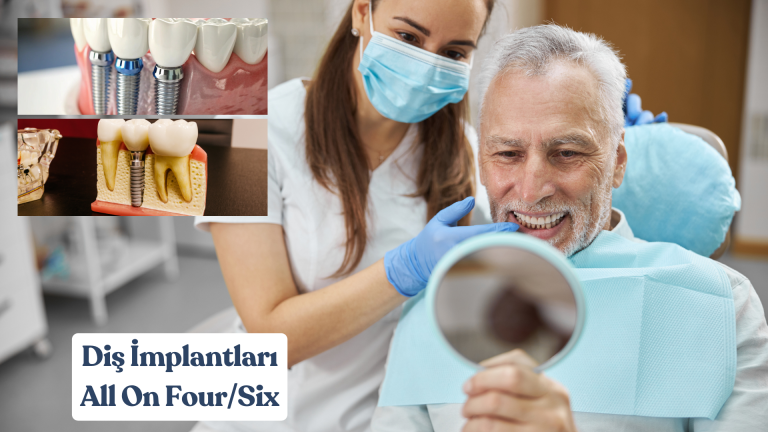 Diş Implantları (All On 4/6)