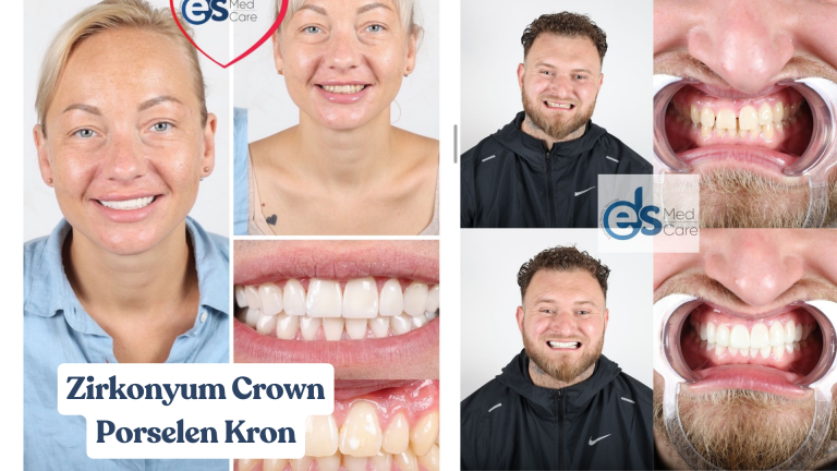 Zirkonyum / Porselen Kron ve Köprüler