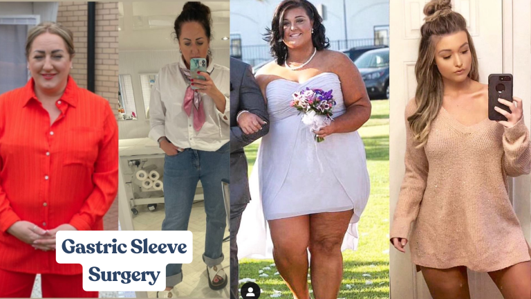 Gastric Sleeve