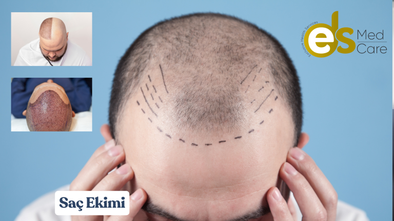 Saç Ekimi
