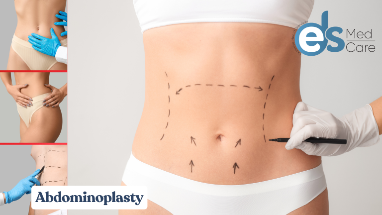 Abdominoplasty (Karın Germe) ve Liposuction (Yağ Aldırma)